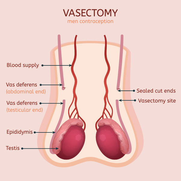 FAQs on Vasectomy  Metromale Clinic & Fertility Center