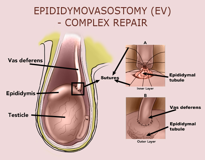 Things to Know About Vasectomy Reversal